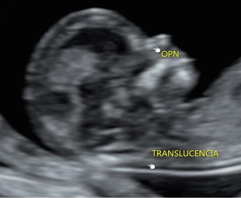 Ultrassom Morfológico De Primeiro Trimestre Origem Med 